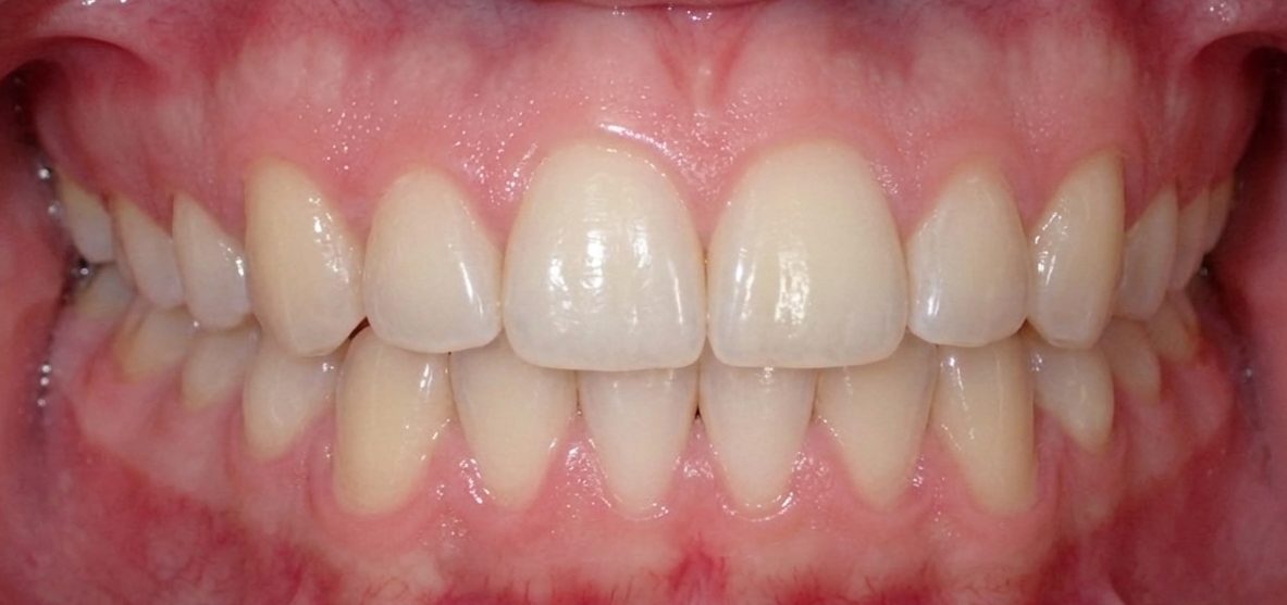 Vivid Smiles patient case 13 before and after treatment comparison after